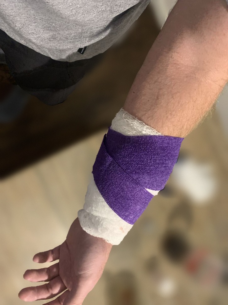 Christian West's left forearm wrapped in a purple bandage the night of a dog bite in Layton, Utah