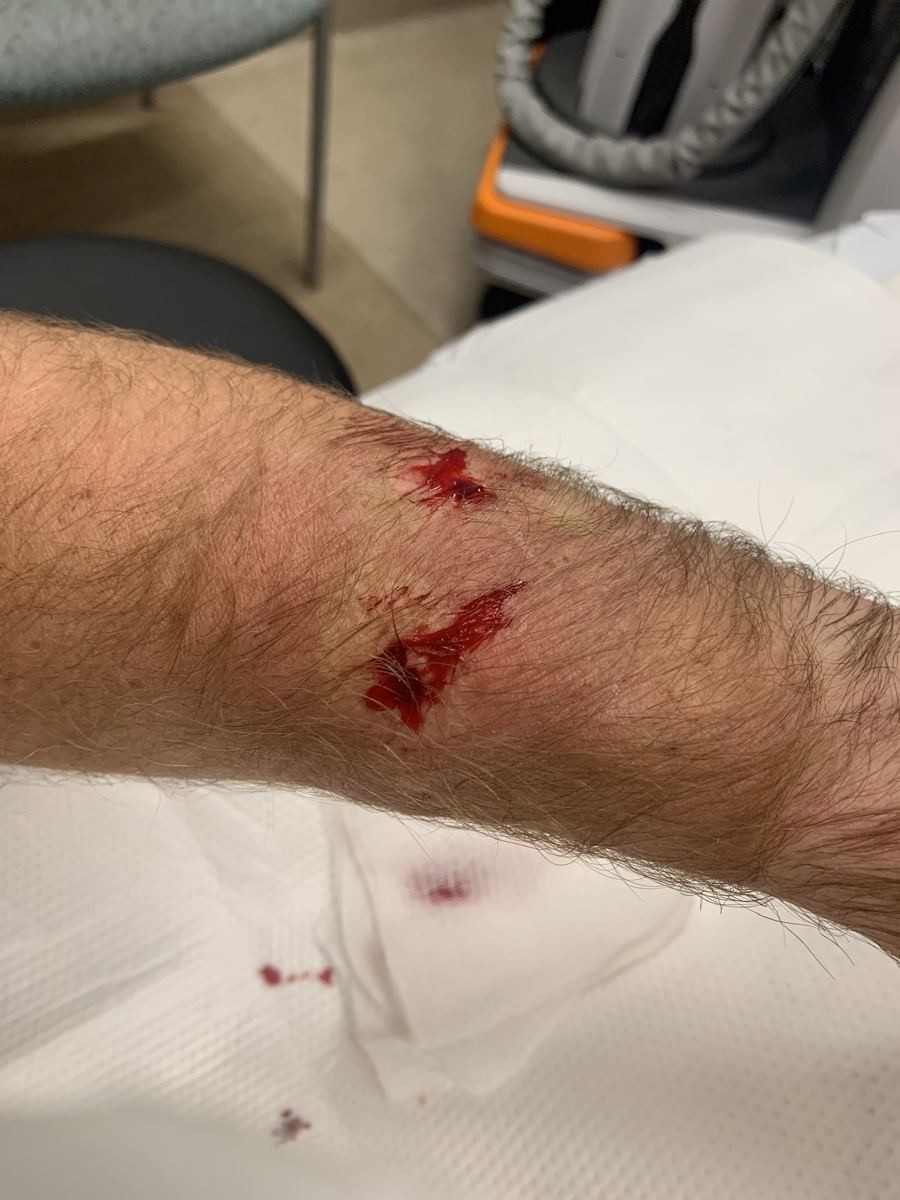 Two dog bite wounds on a forearm in an emergency room before stitches