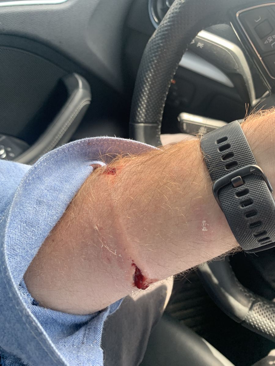 Dog bite puncture wounds on a forearm, photographed in a car minutes after the attack